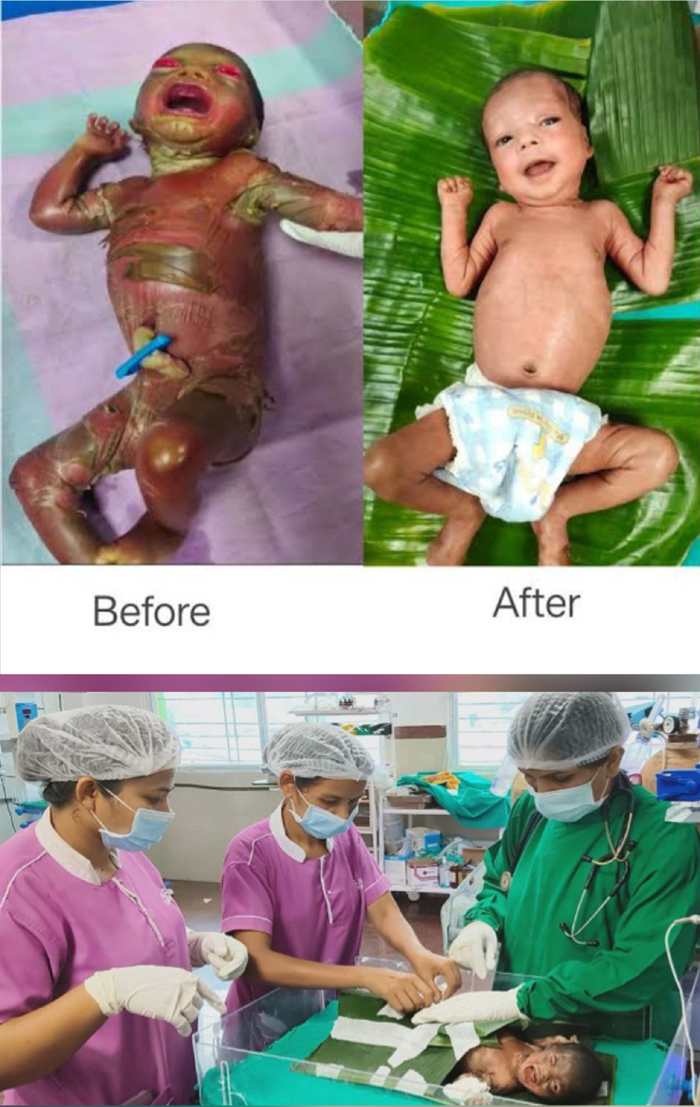 a-rare-skin-disease-was-successfully-treated-using